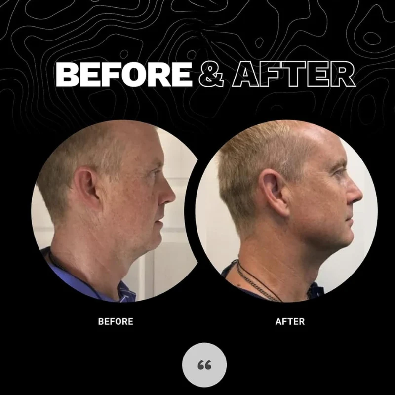 JawSculptr™ – The Ultimate Jawline Shaper - Image 3
